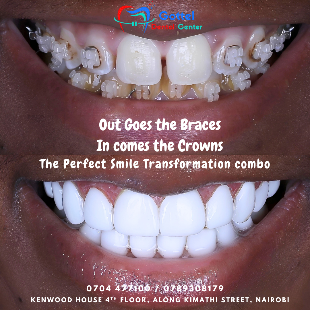 Braces and crowning